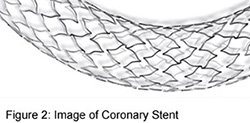 Coronary Angioplasty - Stent